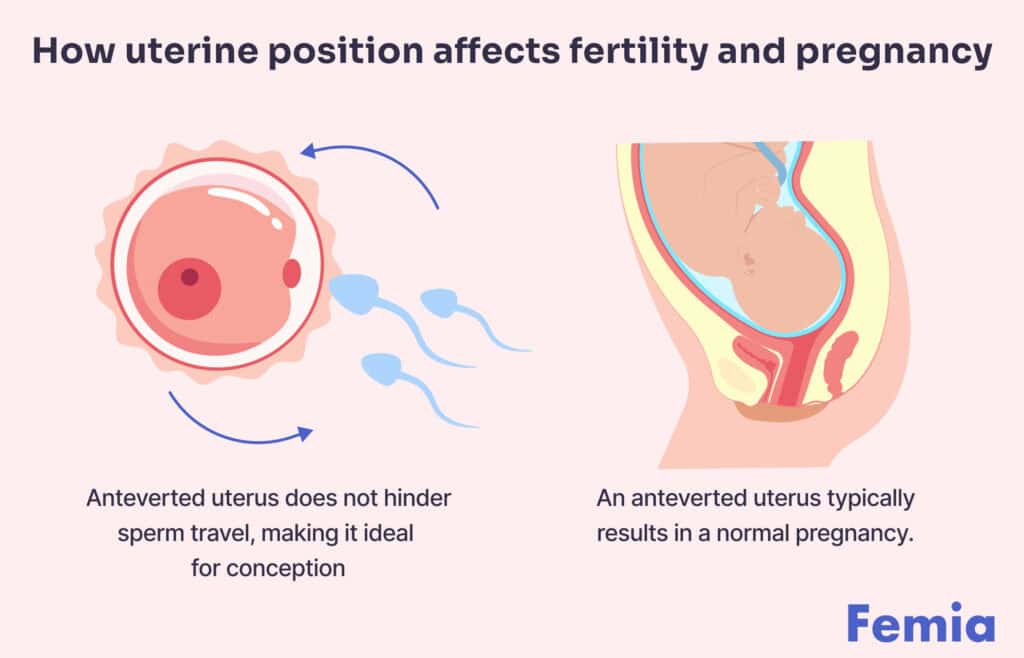 Infographic on how an anteverted uterus affects fertility and pregnancy, indicating it does not hinder conception.