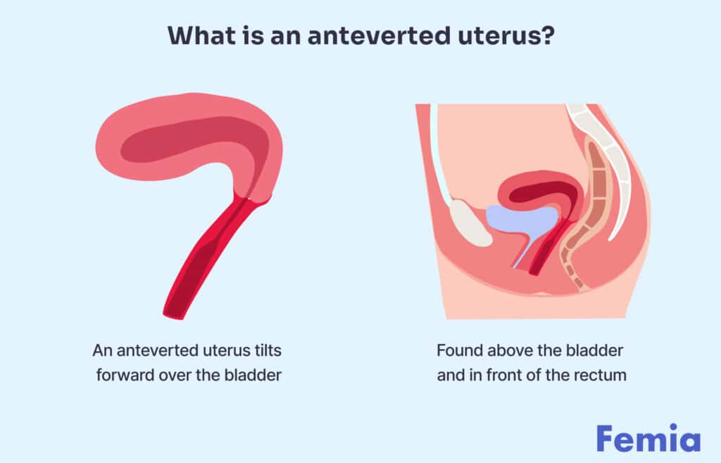 Diagram explaining what an anteverted uterus means, showing it tilting forward over the bladder.