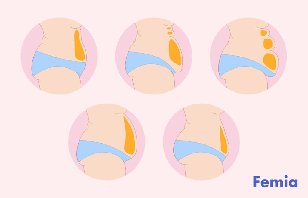 Illustration showing different types of PCOS belly shapes.