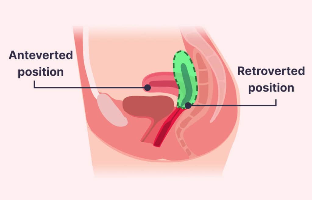 A side view illustration showing anteverted and retroverted positions of the uterus.