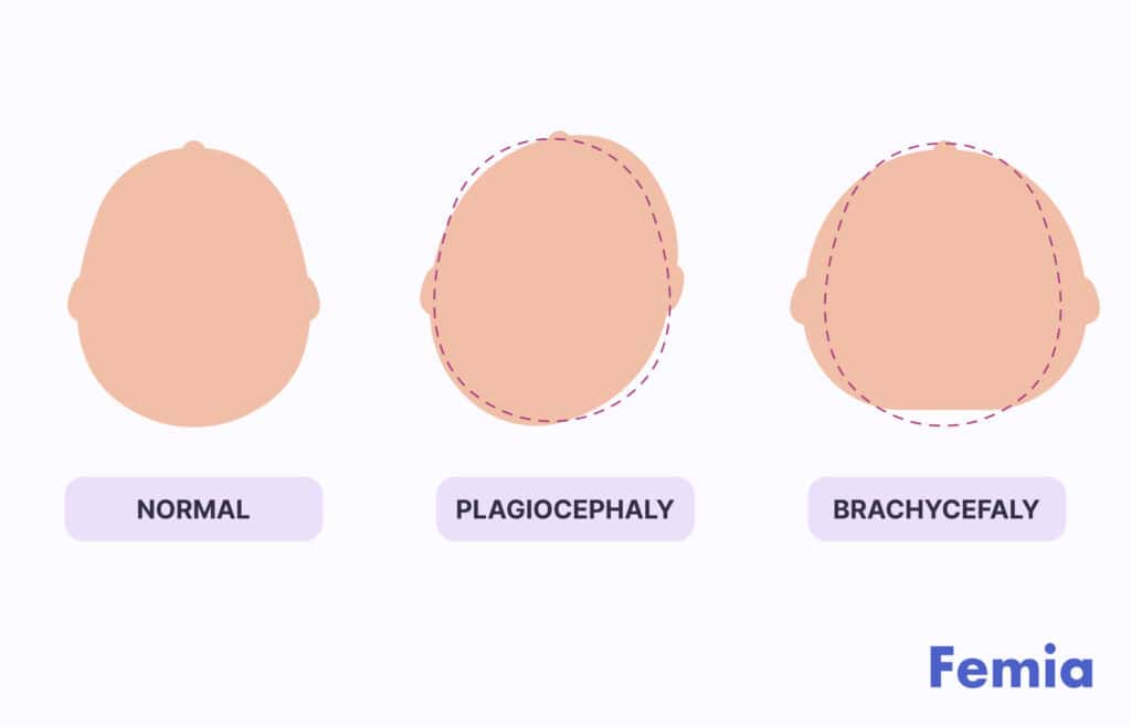 An illustration comparing normal head shape with conditions like plagiocephaly and brachycephaly.