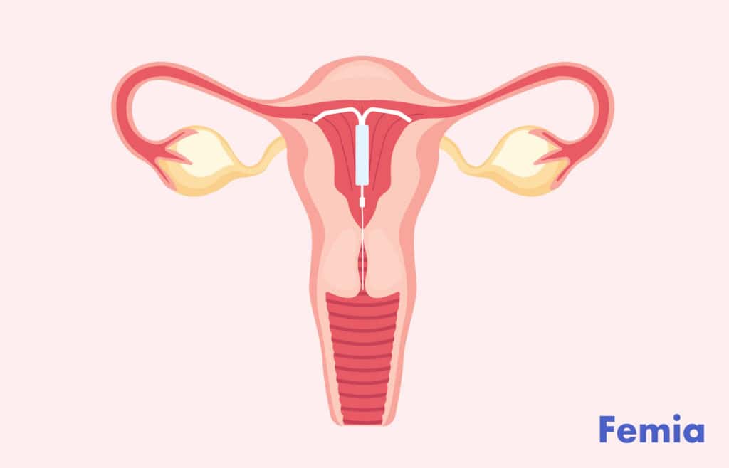 An anatomical illustration of a uterus with an IUD inserted.