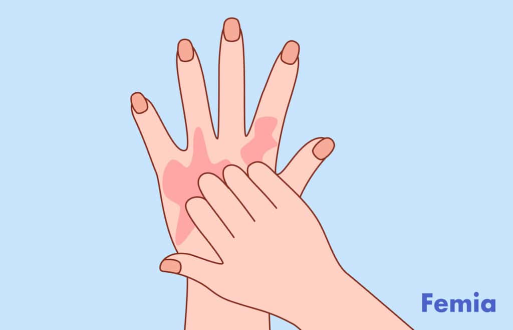 Illustration of a hand with red, itchy patches being scratched by another hand.