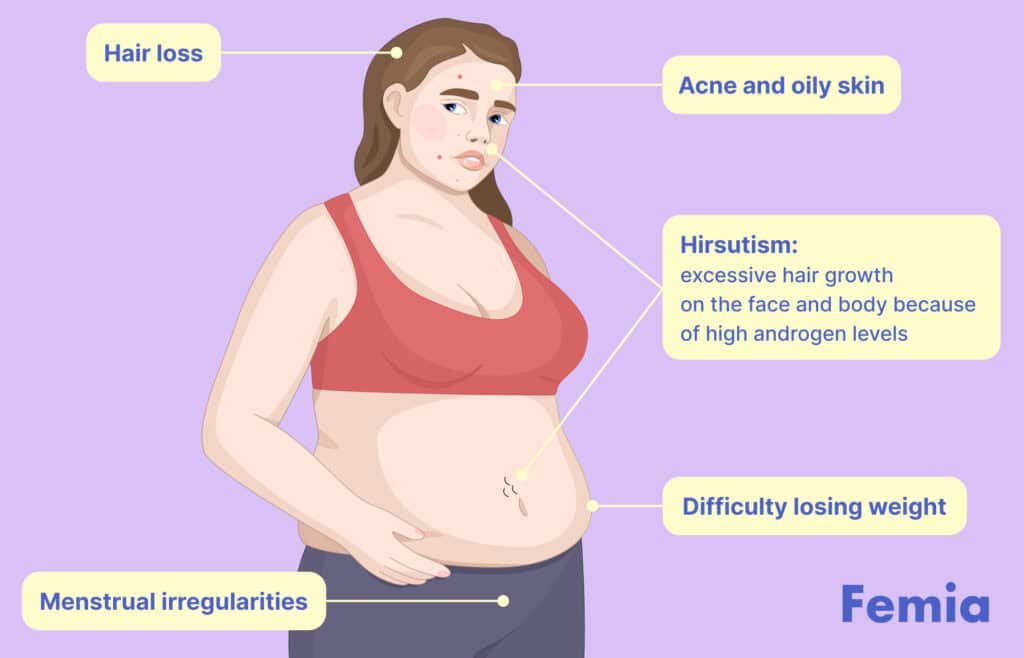 Illustration of a woman with symptoms of PCOS, including hair loss, acne, hirsutism, menstrual irregularities, and difficulty losing weight.