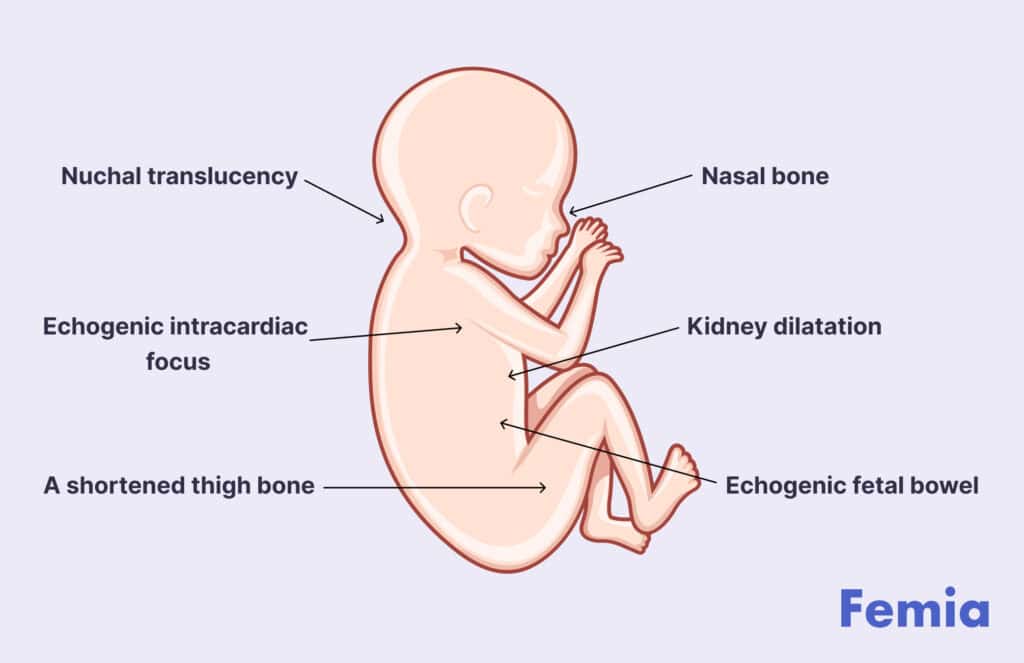 An illustration of a fetus showing Down syndrome ultrasound signs.