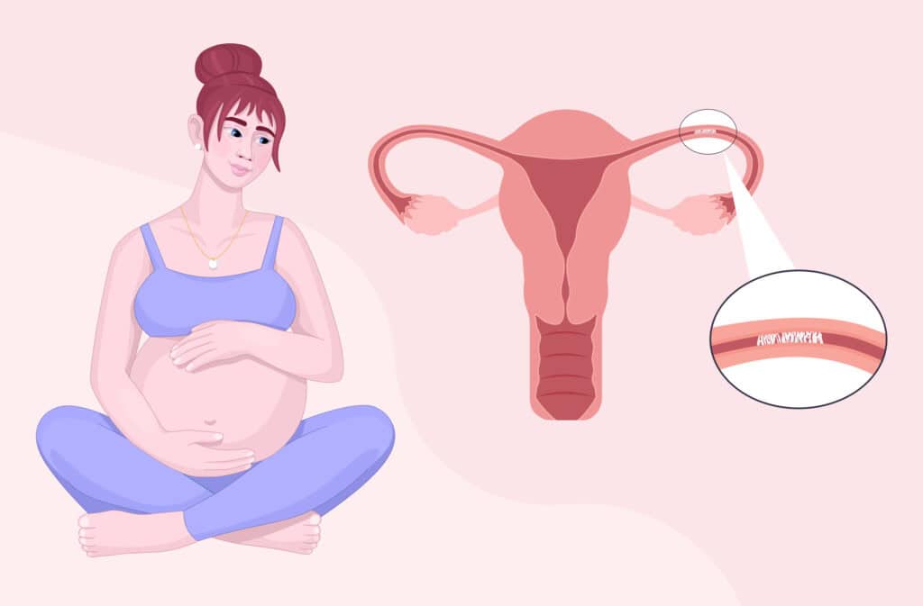 An illustration of a pregnant woman and a uterus with a blocked fallopian tube.