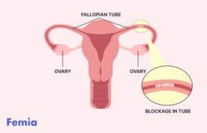 7 steps to getting pregnant with blocked fallopian tubes - Femia Health