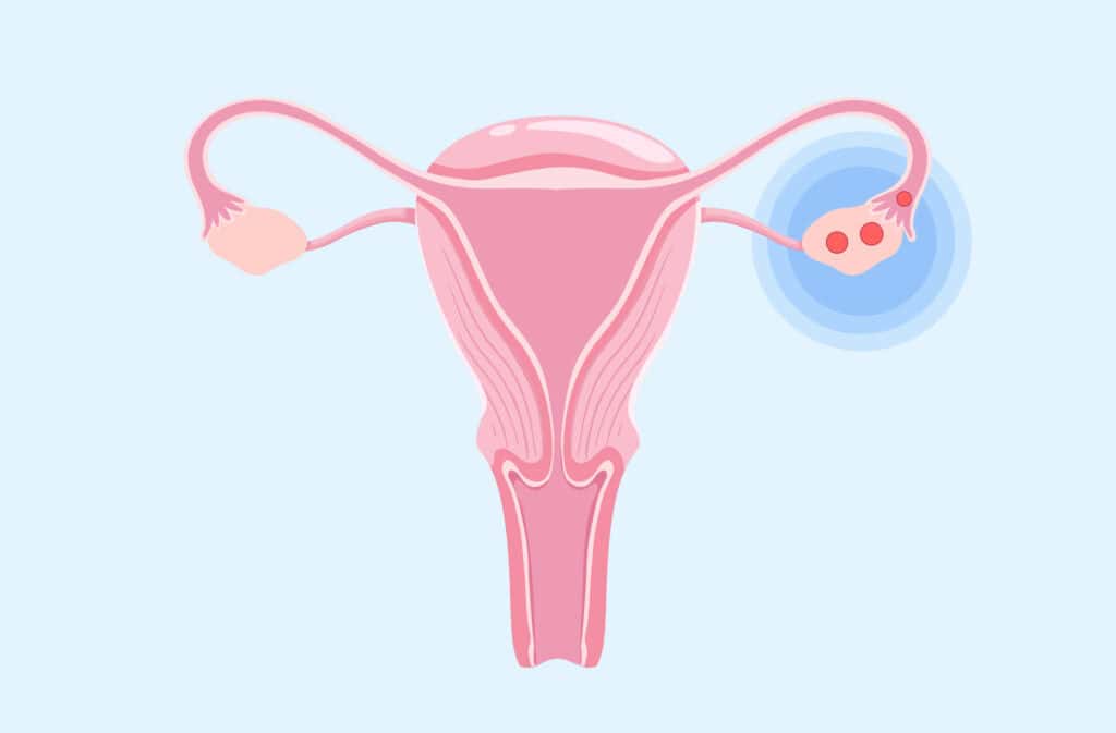 An illustration of women's reproductive organs with two eggs in a ovary meaning hyperovulation.