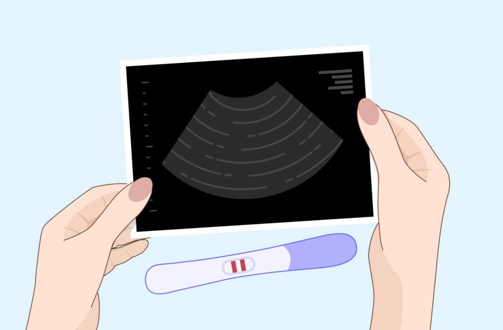 An illustration of a positive pregnancy test but no baby on ultrasound.