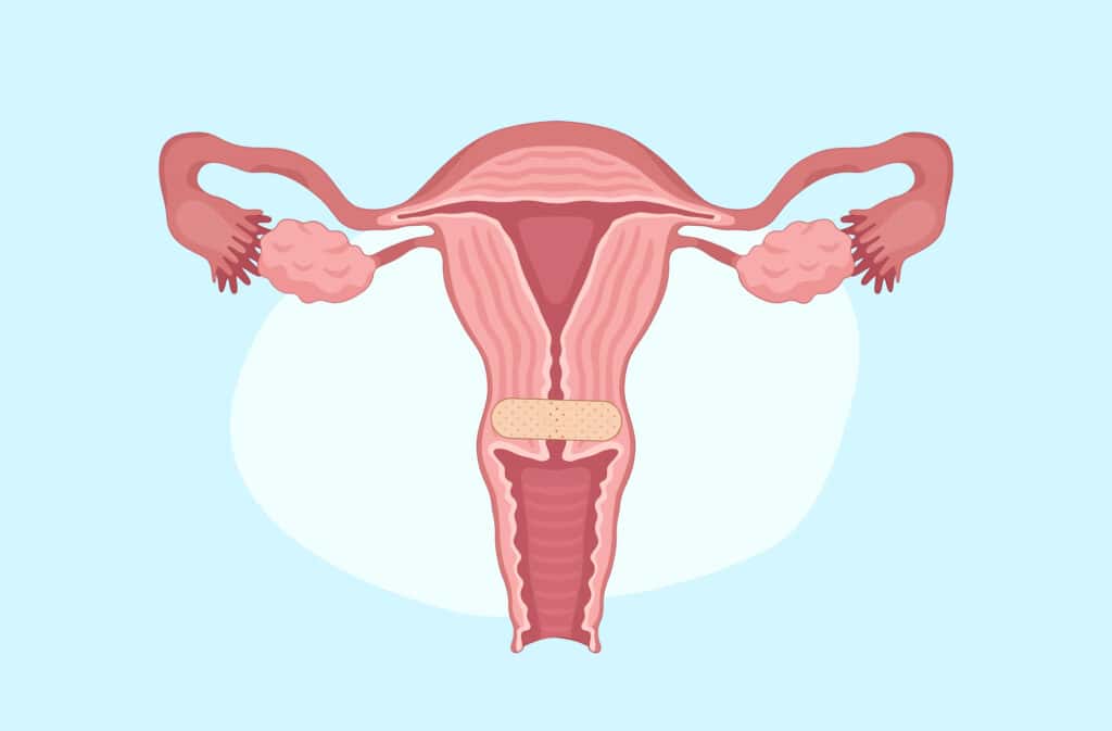 An illustration of a bruised cervix.