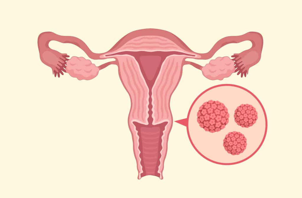 An illustration of a uterus with HPV cells representing if HPV can cause infertility.