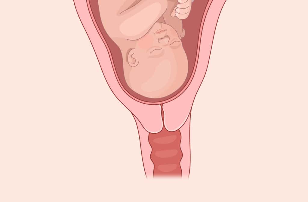 An illustration of a baby in a cervix.