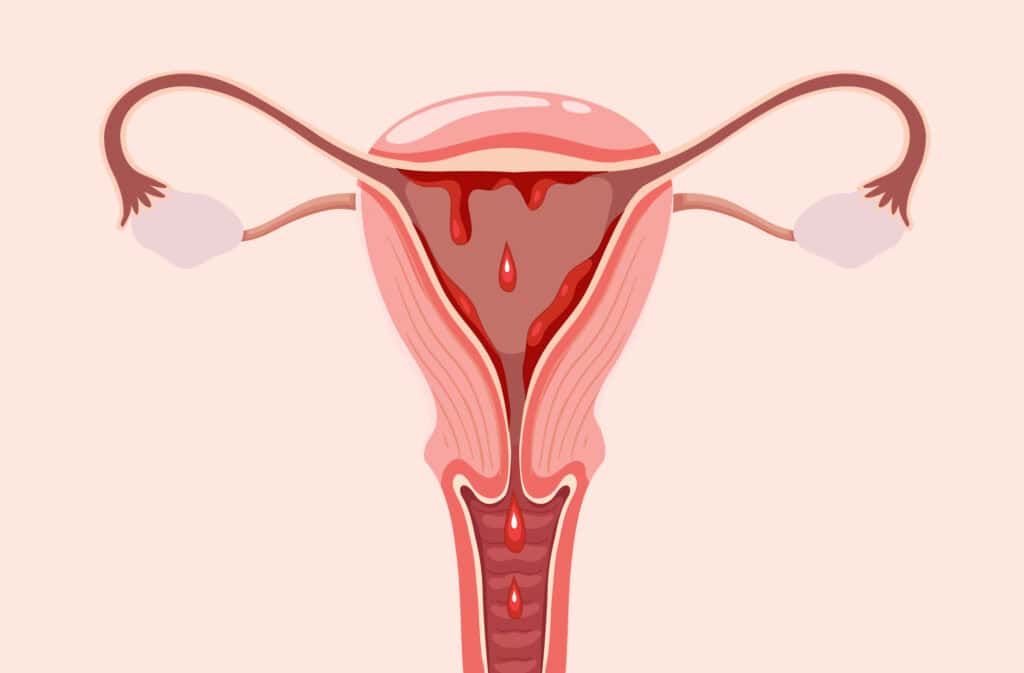 An image of a uterus with shedding lining representing a menstrual phase.