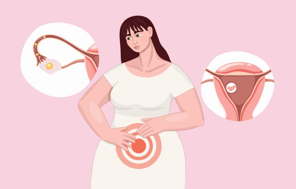 An illustration of a woman experiencing an ovulation cramps or implantation cramps