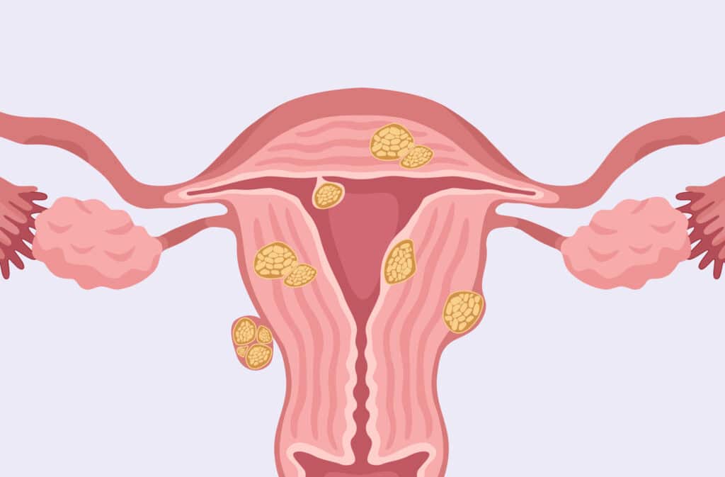 An illustration of uterine fibroids representing fibroids and pregnancy.