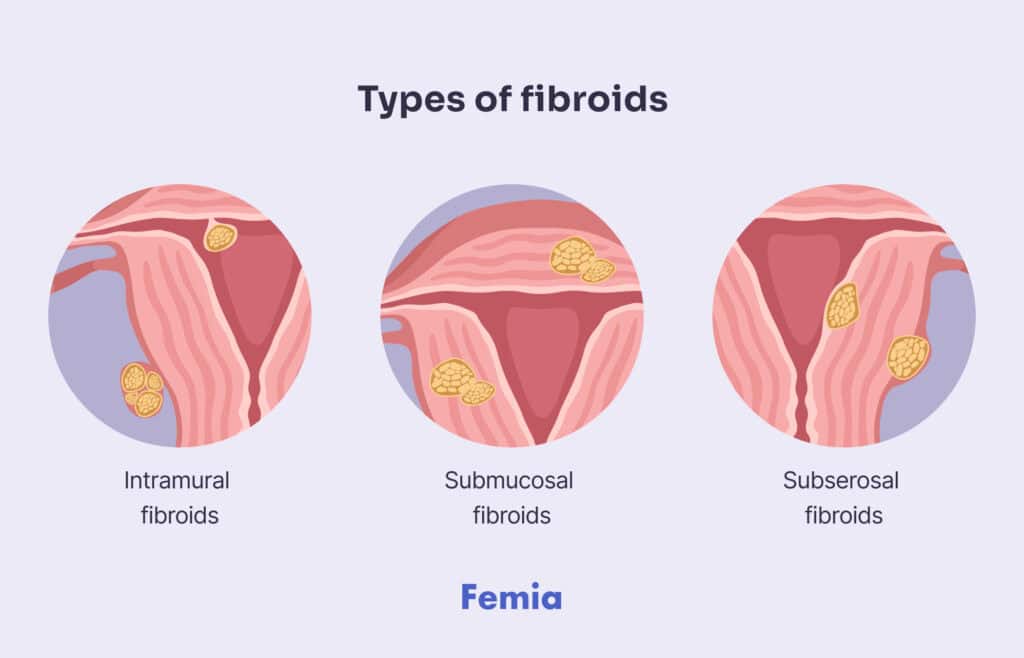 An illustration showing 3 types of fibroids.