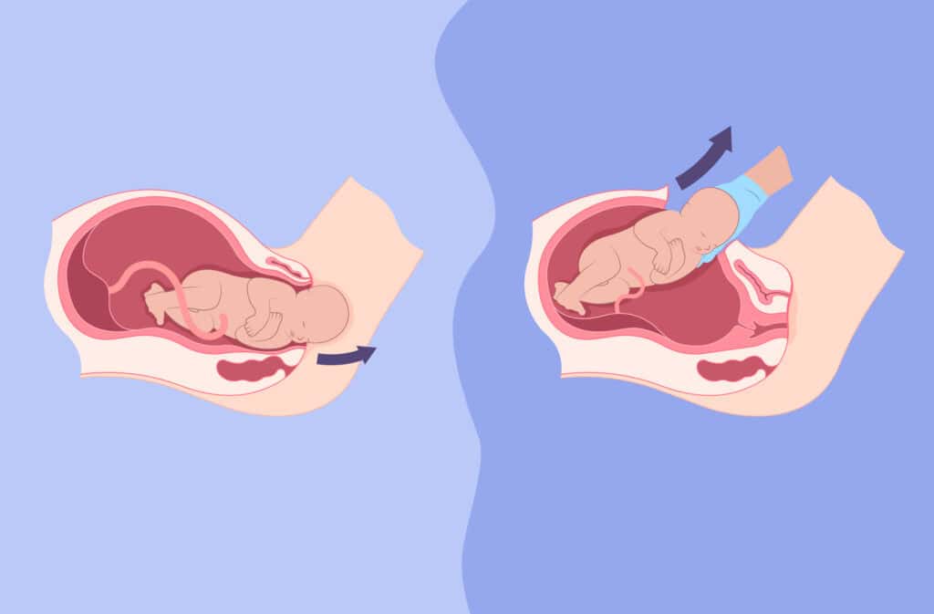 A photo of two babies in a process of birth representing C-section vs vaginal birth.