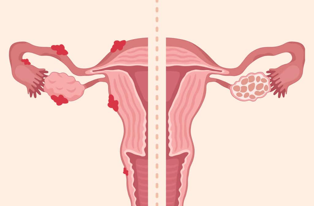 An illustration of a uterus showing the difference PCOS vs endometriosis.