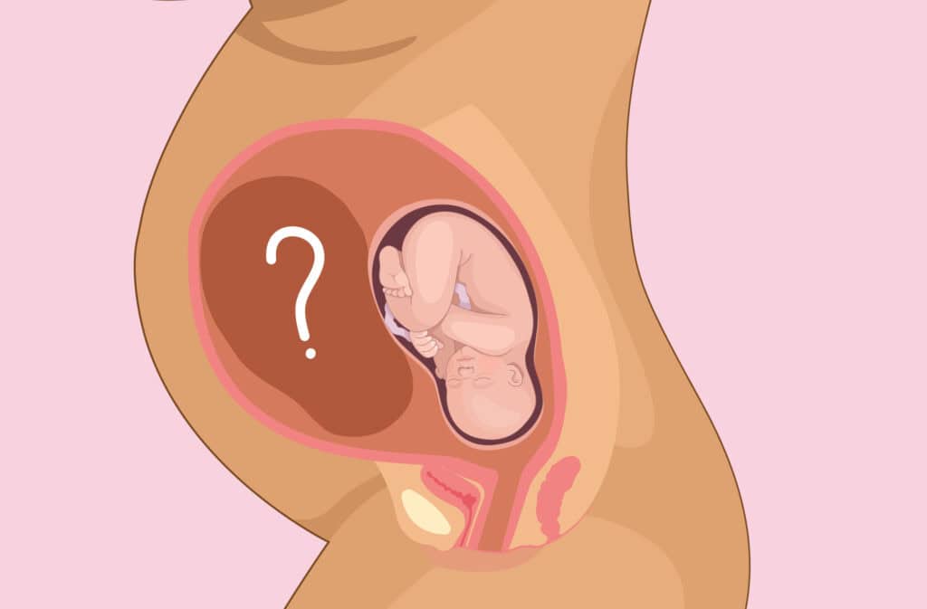 An illustration of a pregnant belly with two fetuses showing vanishing twin syndrome.