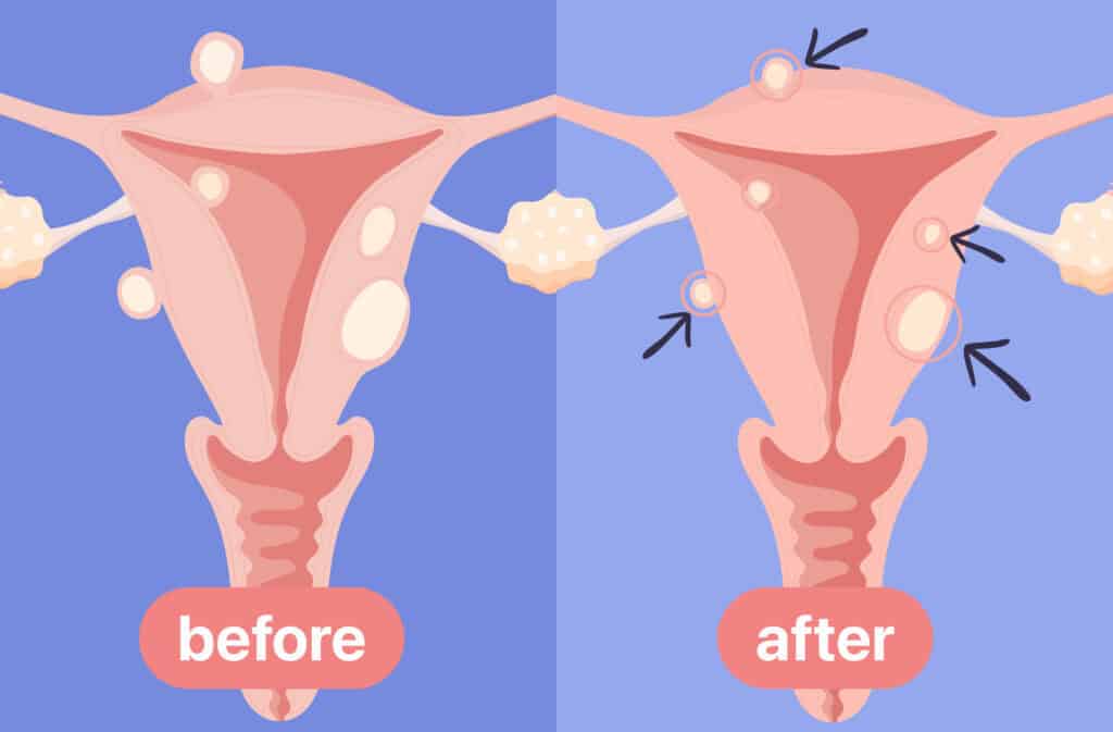 An illustration of a uterus covered in fibroids on the lest side and How to shrink fibroids naturally oh the right side.