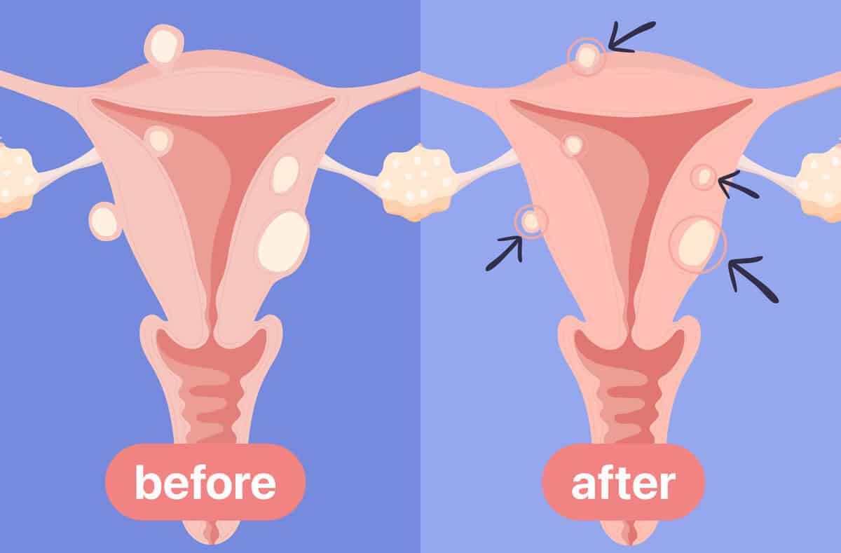 does glutathione shrink fibroids  In F&S Science: Extracellular vesicles released by uterine fibroid cells: Modulation by omega-3 fatty acids and impact on recipient myometrial cells Full text  https://www.fertstertscience.org/article/S2666-335X(26)00028-5/abstract How To Shrink Fibroids Naturally