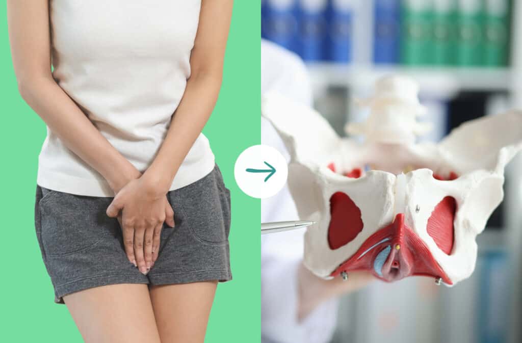 A photo of a woman crossing her legs and holding her crotch on the left and a plastic model of a pelvis on the right, representing a hypertonic pelvic floor.