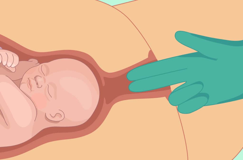 An illustration of a baby inside the uterus and a doctor's hand checking a real dilated cervix.