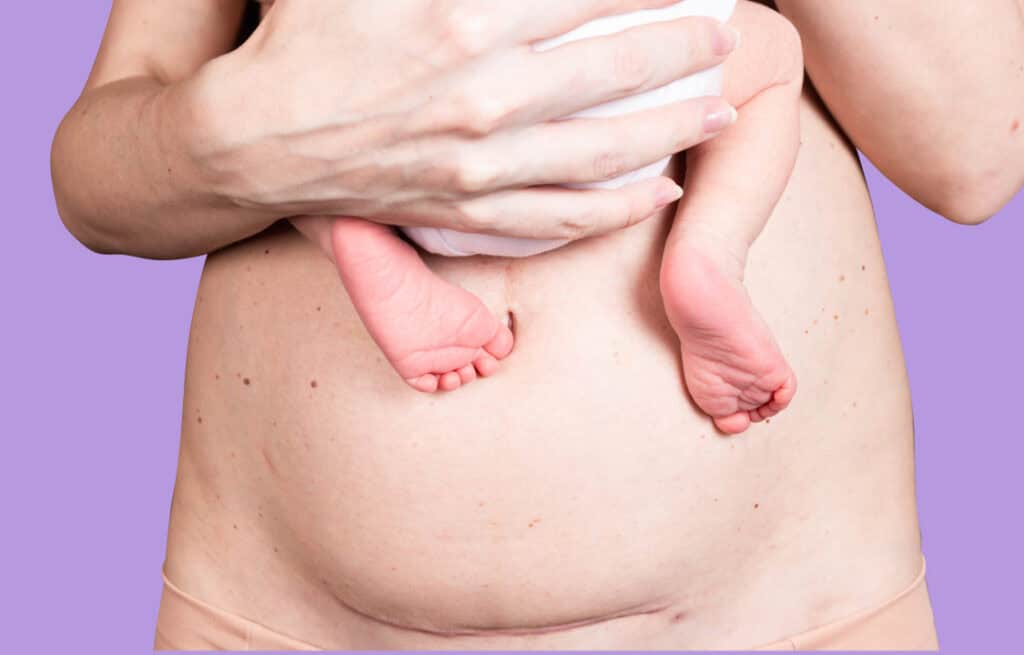 A photo of a mom showing her belly and holding her newborn baby while wondering How to lose postpartum fat.