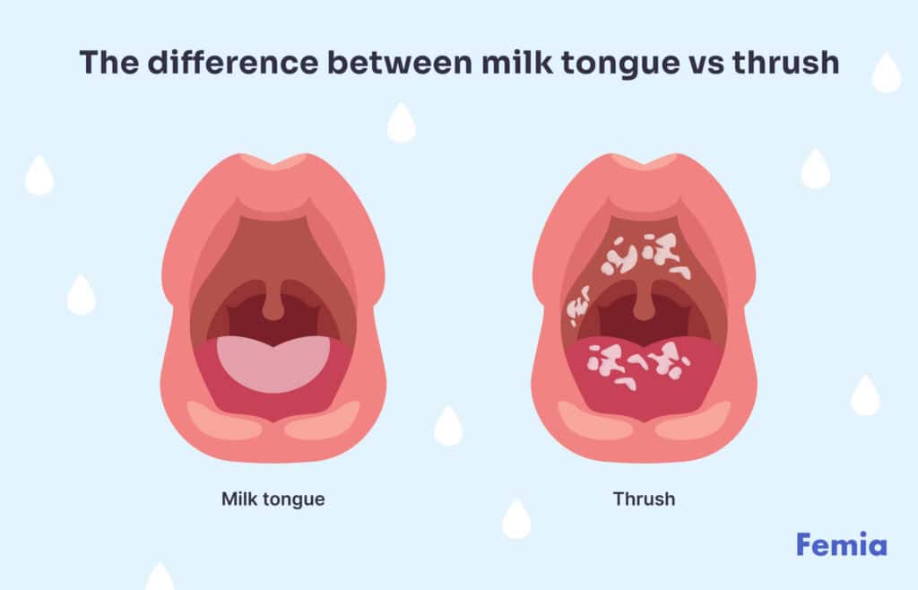 An infographic showing the difference between milk tongue vs thrush.